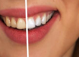 Know best home remedies to whiten teeth naturally