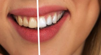 5 Natural Home Remedies to White, Bright & Shiny Teeth in Just 5 Days
