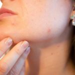 cismis – get rid of pimples