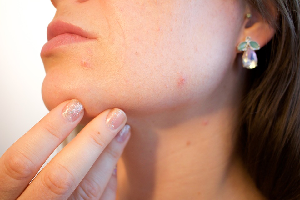 cismis get rid of pimples - Acne Problem: 5 ways to Get Rid of Pimples in Just 5 hours